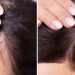 Alopecia androgenética tem tratamento?